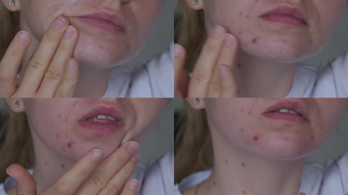 不认识的女人用化妆品，面霜精华治疗脸上的痤疮。女性脸部特写痘痘，伴有皮疹、疤痕和斑点，对化妆品过敏。