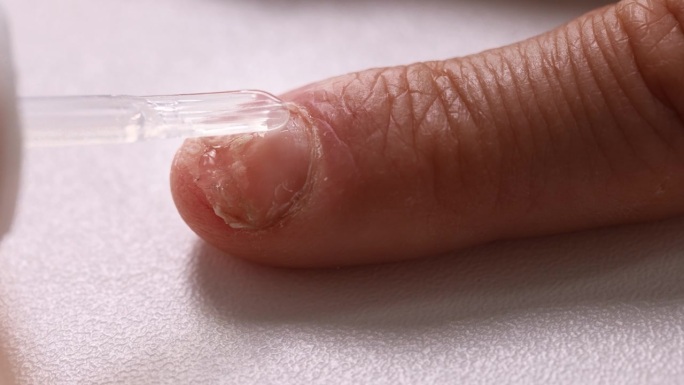 真菌指甲感染治疗。将阿莫罗芬防真菌漆涂在手指甲上