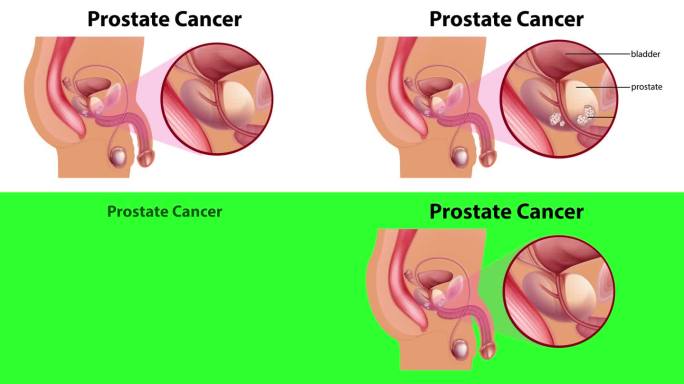 男性前列腺癌解剖动画