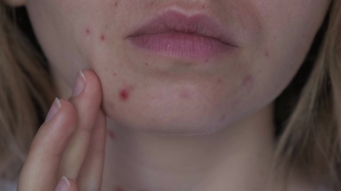 面目全非的女人露出脸上的粉刺。女性脸部特写痘痘，伴有皮疹、疤痕和斑点，对化妆品过敏。问题护肤与健康理