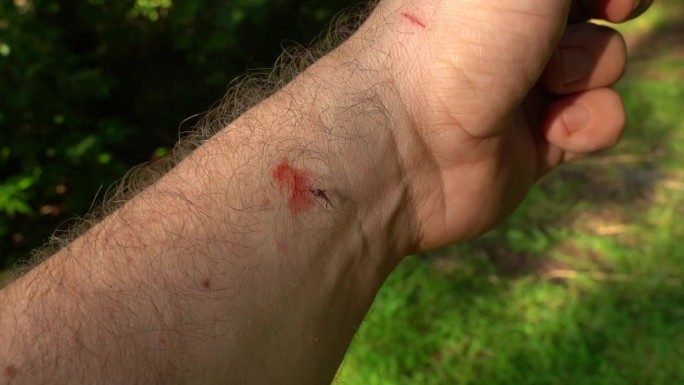 那人打死了一只蚊子，蚊子咬了他的胳膊，把血弄得他胳膊上都是。