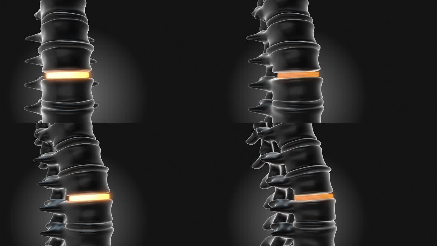 腰椎植入物稳定脊柱
