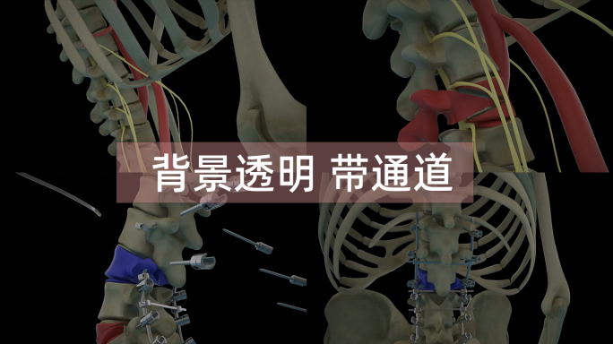 脊椎 腰椎截骨矫正手术三维动画 透明背景