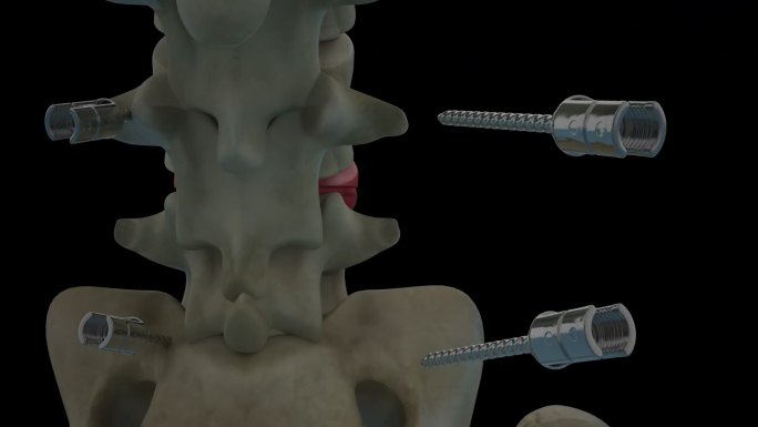 脊椎 腰椎截骨矫正手术三维动画 透明背景