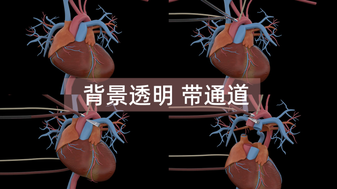 心肺旁路手术 心脏摘除移植手术 透明通道