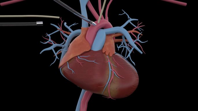 心肺旁路手术 心脏摘除移植手术 透明通道