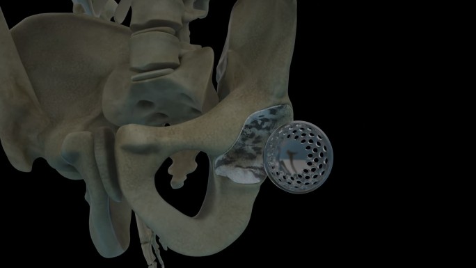 髋关节置换（人工髋关节置换）手术医学动画