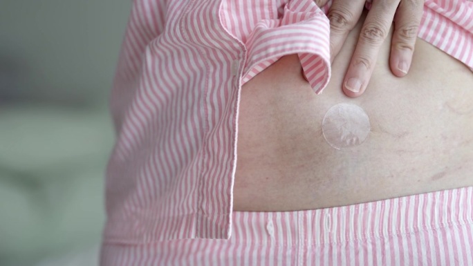 亚洲妇女腹部使用激素替代疗法贴片