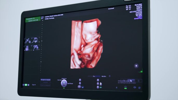 超声机显示器上未出生婴儿的三维图像。妊娠检查。