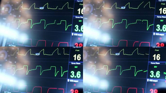 心率曲线在黑屏上运行。人工肺呼吸机在手术室工作。特写镜头。