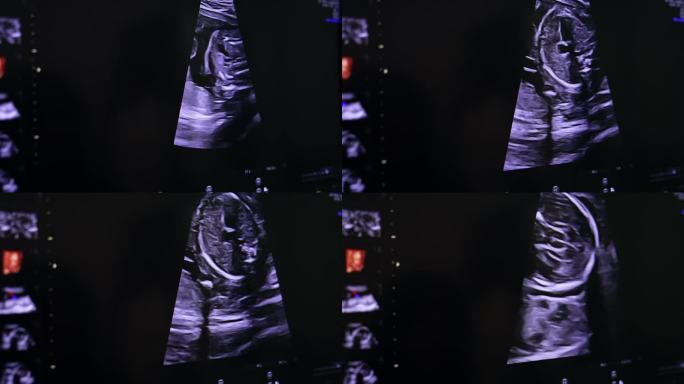 妊娠超声扫描。在出生前检查婴儿的发育情况。