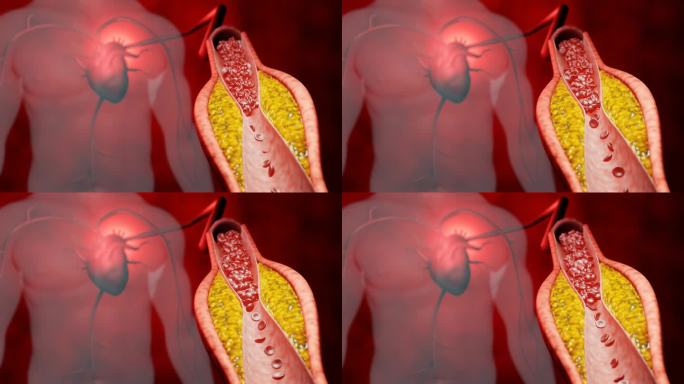 高脂血症。动脉阻塞的概念和人体血管作为一种疾病与胆固醇脂肪堆积堵塞。动脉阻塞，动脉中的胆固醇斑块。三