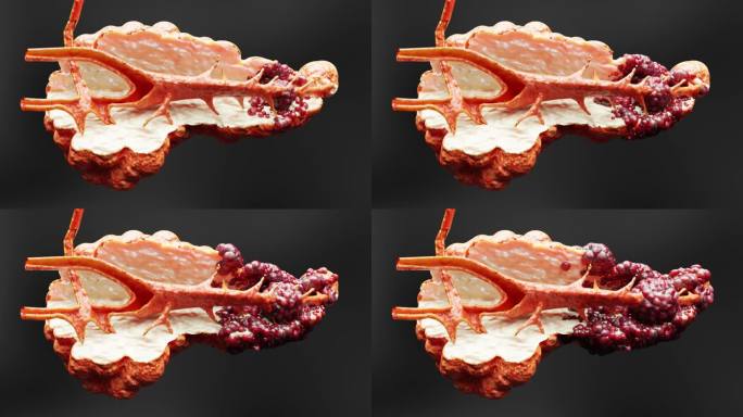 胰腺疾病，消化腺，人胰腺癌解剖图，医学准确，恶性肿瘤生长扩散，细胞突变，癌细胞转移，3d渲染