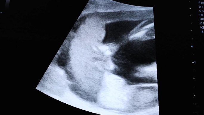 对监视器的怀孕画面进行筛选。屏幕截图。紫外线