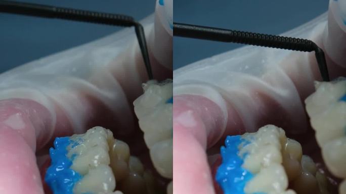 液体围护隔绝牙龈的作用，一种漂白剂optragat旋转播撒机，近距离拍摄患者牙齿在牙科诊所美白过程中