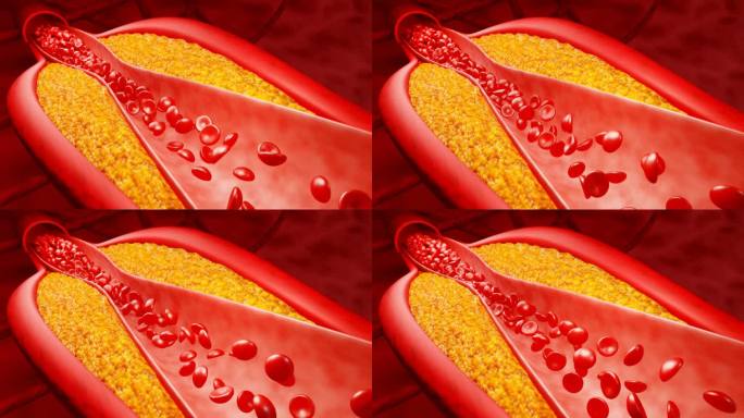 高脂血症。动脉阻塞的概念和人体血管作为一种疾病与胆固醇脂肪堆积堵塞。动脉阻塞，动脉中的胆固醇斑块。三