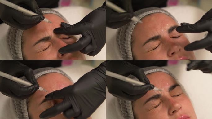美容师用笔在病人额头上标出要注射肉毒杆菌的地方