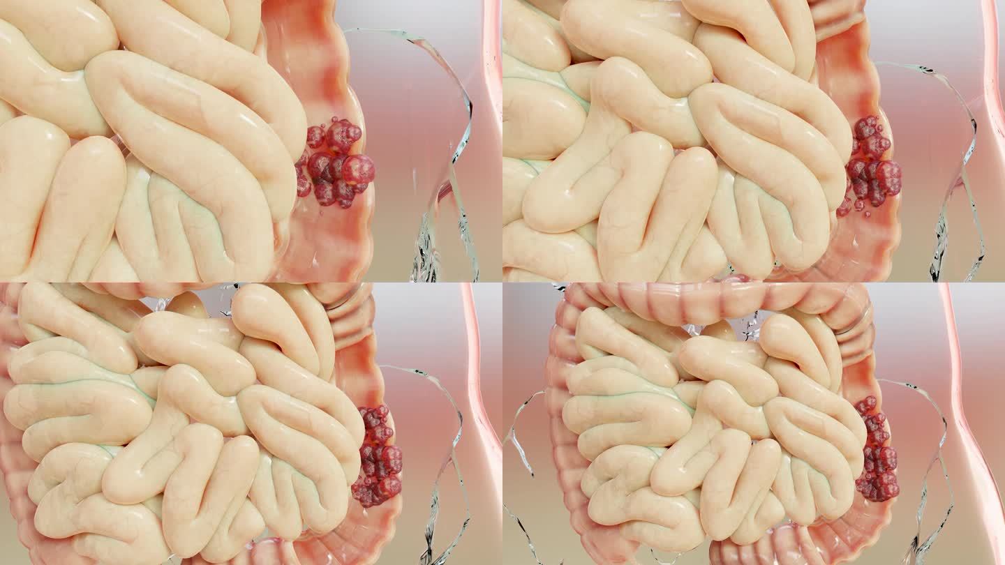 肠癌或结直肠癌、结肠癌、肠炎性疾病、肠痛、乳糜泻、感染、复制、细胞扩张、恶性癌、病毒、3d渲染