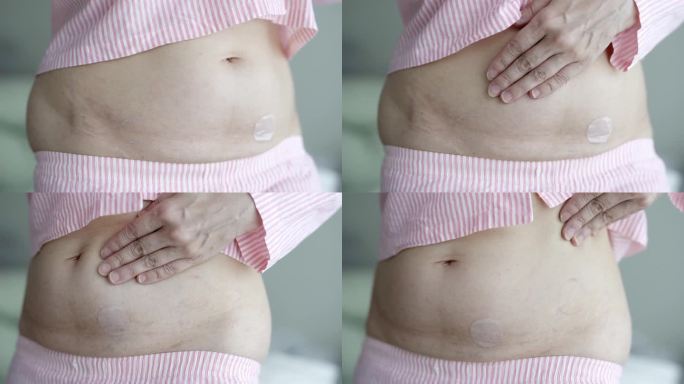 亚洲妇女腹部使用激素替代疗法贴片