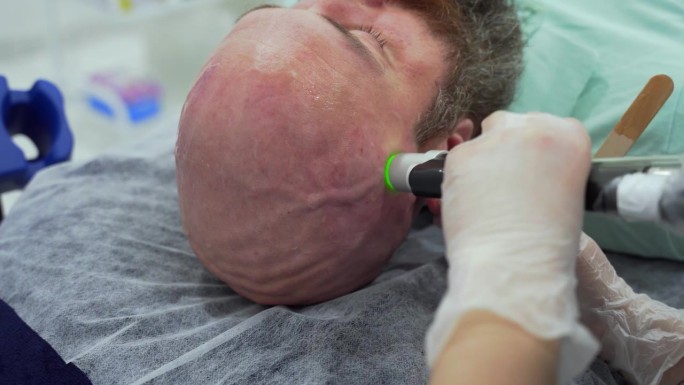大胆男士头部脱毛激光脱毛手术治疗采用翠绿宝石激光，无痛的过程，美容理念，