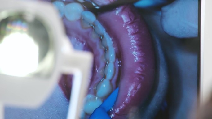 牙医用显微镜检查病人牙齿的截图