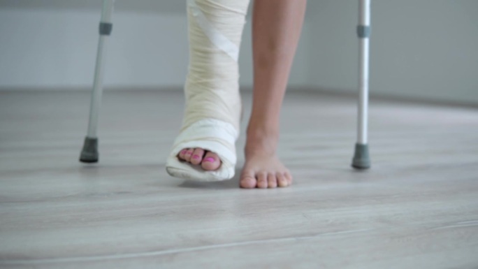 用拐杖走路时用石膏打石膏的女性断腿特写，腿部受伤后的康复概念
