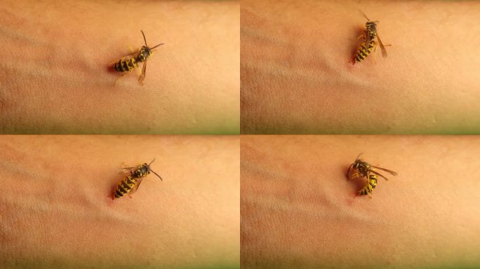 外来兽医的手臂被黄黄蜂蜇伤。
刺痛得很厉害。
值得注意的是，黄蜂能够在不受伤害的情况下收回毒刺。
德