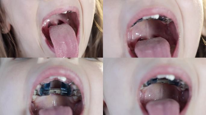 小女孩张开嘴，露出她长长的舌头、喉咙和下巴扩张器。