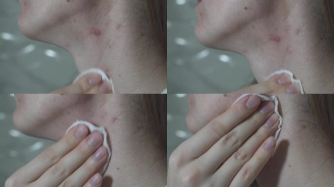 女孩用海绵擦拭脖子上的皮肤。有痤疮问题的女性的油性皮肤。脸上的伤疤和伤口。医疗镜头。近一点，4k。
