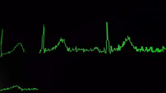 心电图波形曲线波动行情