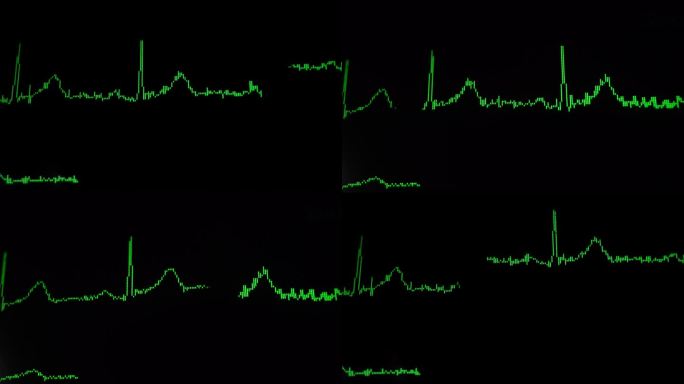 心电图波形曲线波动行情
