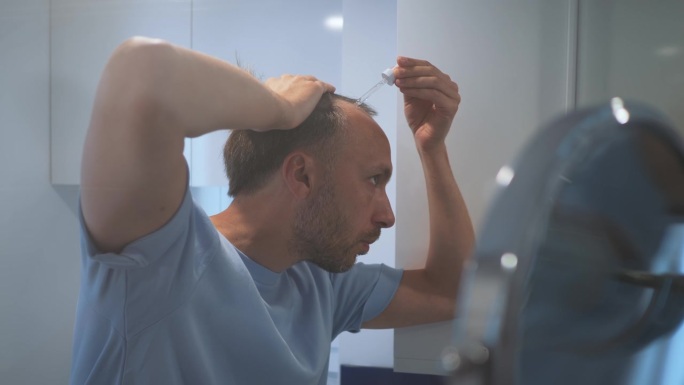 年轻的秃顶男子用移液管滴强化血清滴在发根上，用于生长刺激和治疗