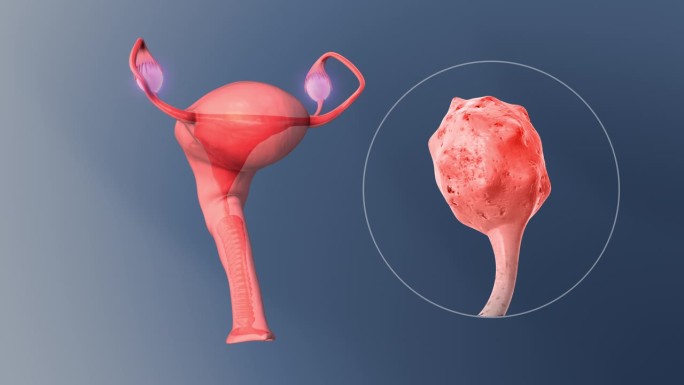 多囊卵巢综合征是一种已经扩散到输卵管、子宫或子宫的卵巢癌。