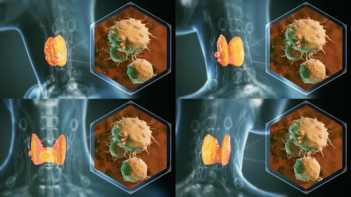 妇女的甲状腺癌3d人体全息人体三维人体器