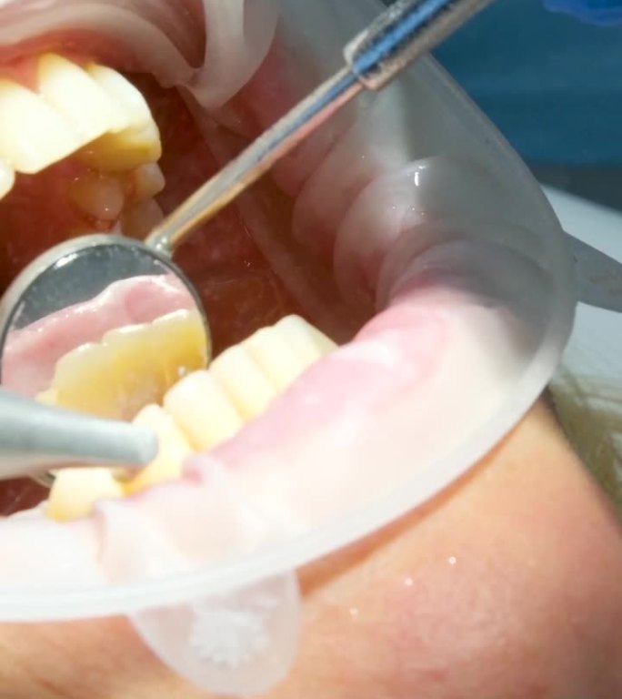 牙科妇女刷牙清洁去除牙菌斑结石唾液喷射器使用口腔镜最新技术喷砂镜水滴溅到两侧操作口扩张器