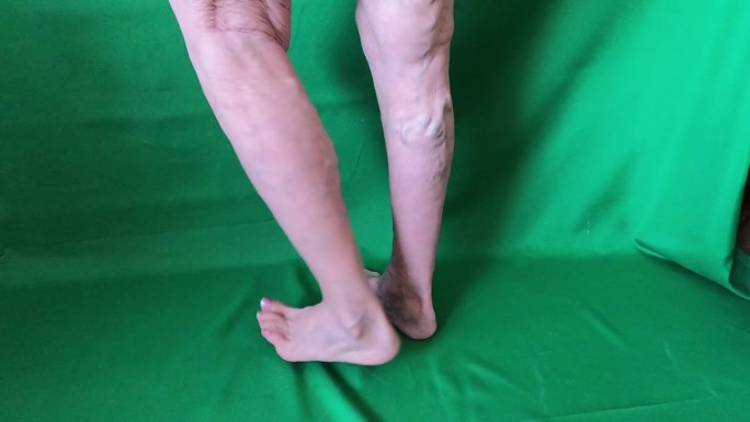 一位年长女性腿部的静脉曲张