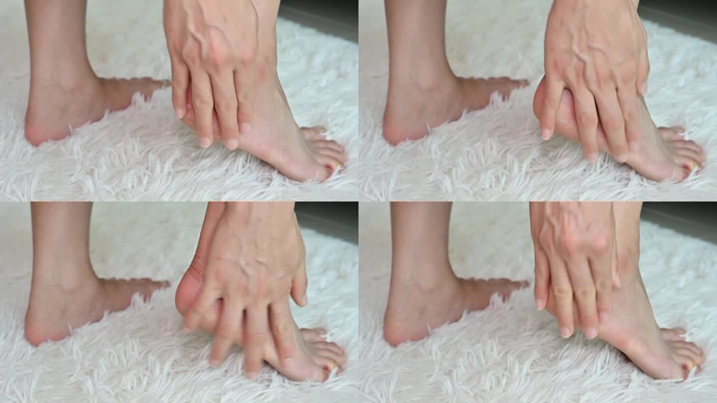 一名女子用保湿霜治疗脚后跟皲裂的照片。