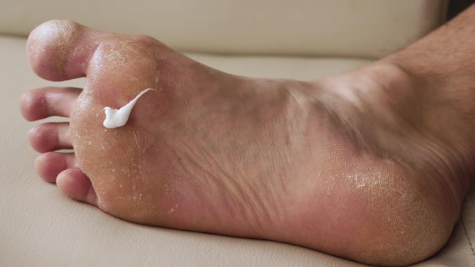 乳霜治疗足部皮肤干燥，足部牛皮癣皮肤受损。皮炎、湿疹、牛皮癣、过敏反应。诊断脱皮和裂缝的人的腿。真菌