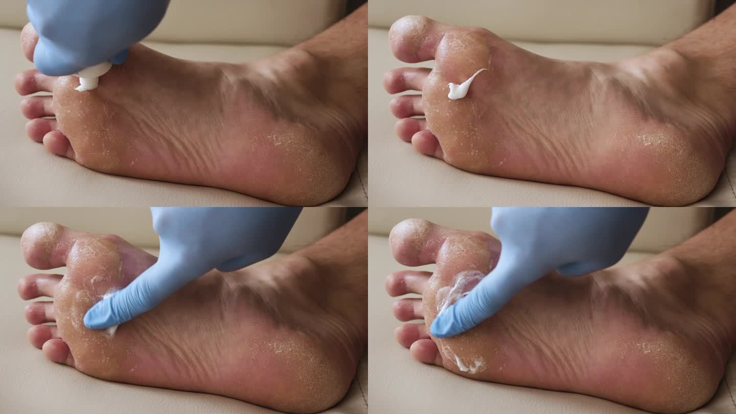 乳霜治疗足部皮肤干燥，足部牛皮癣皮肤受损。皮炎、湿疹、牛皮癣、过敏反应。诊断脱皮和裂缝的人的腿。真菌