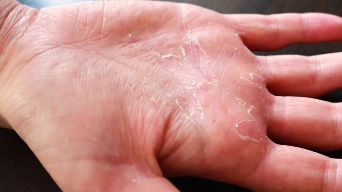 一个女孩的手的特写，皮肤受损，由于环境和皮肤因素，显示出干燥，开裂和脱皮的迹象