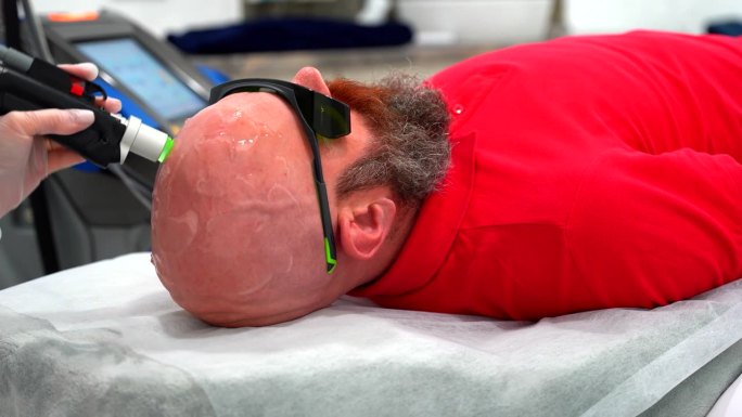 大胆男士头部脱毛激光脱毛手术治疗采用翠绿宝石激光，无痛的过程，美容理念，