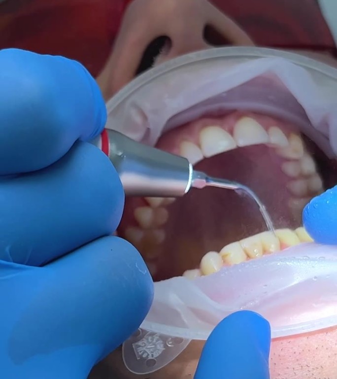 在一家牙科诊所，一名男医生给另一名男子刷牙，他戴着蓝色手套，戴着口罩，病人的嘴是张开的，嘴里有唾液喷