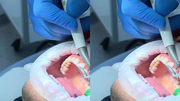 在一家牙科诊所，一名男医生给另一名男子刷牙，他戴着蓝色手套，戴着口罩，病人的嘴是张开的，嘴里有唾液喷