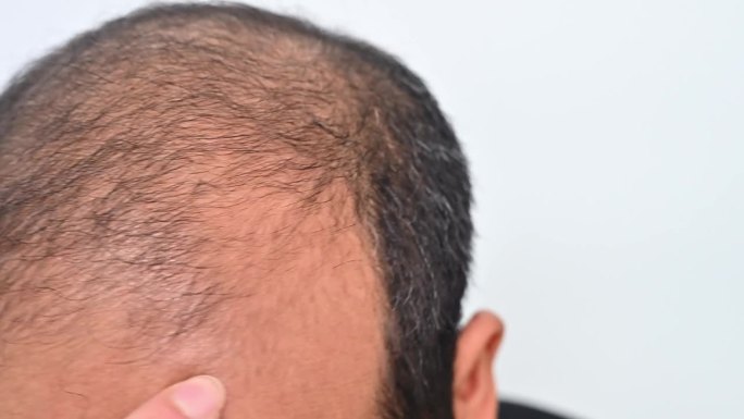 有人用手触摸亚洲秃顶男子的头皮，检查脱发问题。