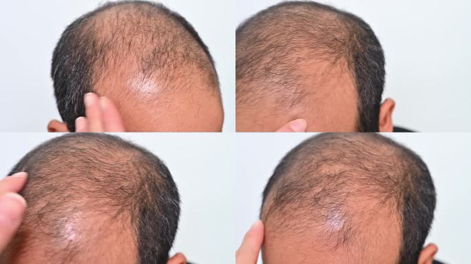 有人用手触摸亚洲秃顶男子的头皮，检查脱发问题。