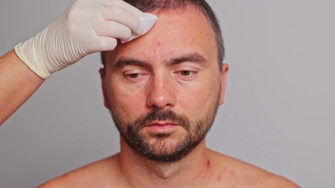 男人额头有痘痘、红斑、皮肤病