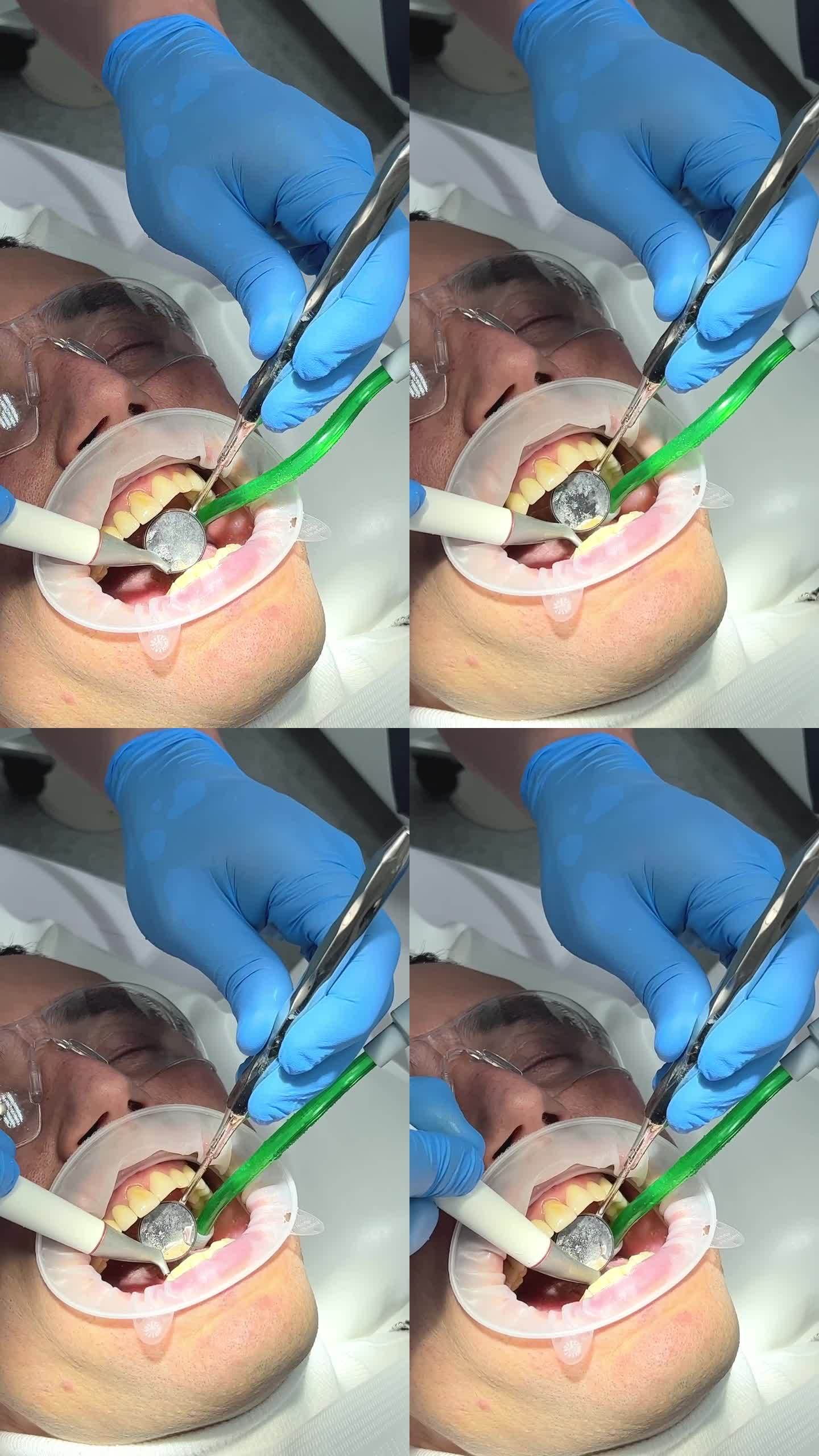 牙齿清洁中年男子牙菌斑牙石在口腔、嘴唇和脸颊牵开医生4手清洁牙齿吸菌斑可见蓝色无菌手套治疗牙科诊所最