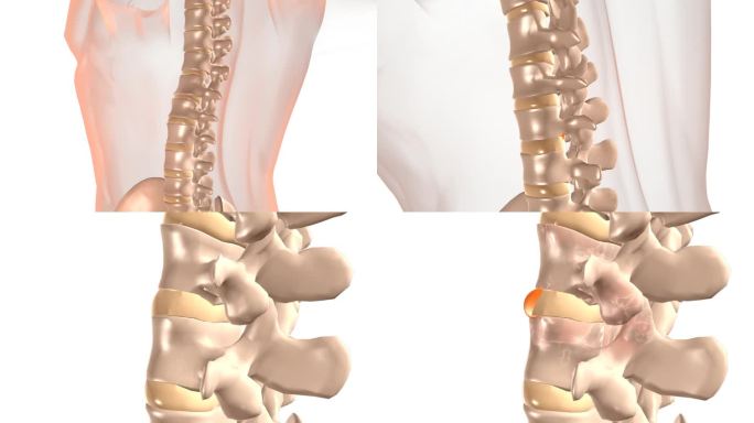腰椎间盘突出脊髓 髓核 髓核破裂积液溢出