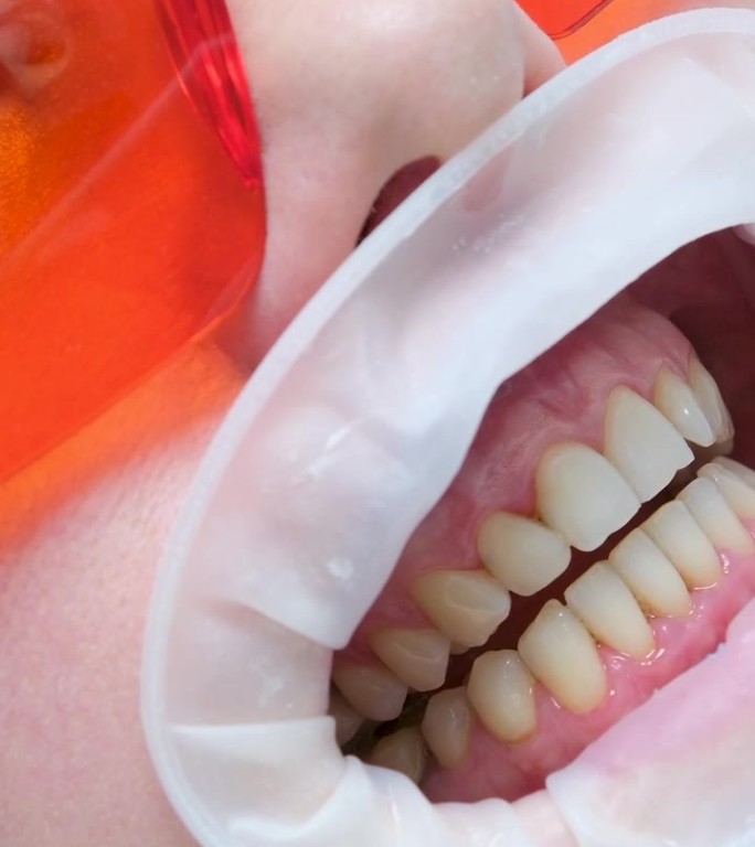 经典的牙齿染色用于确定牙齿的颜色optragate口扩张器妇女牙齿颜色匹配后美白特写脸在紫外线防护眼