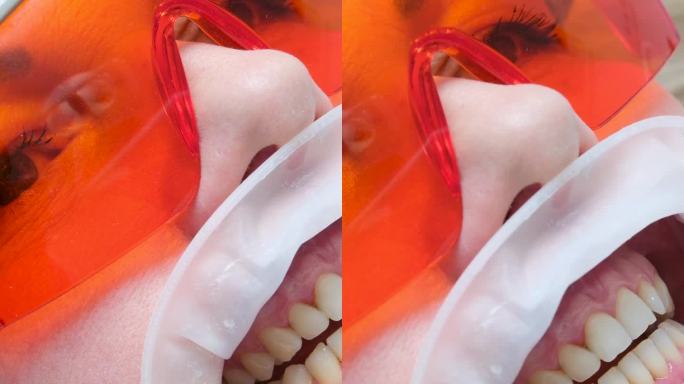 经典的牙齿染色用于确定牙齿的颜色optragate口扩张器妇女牙齿颜色匹配后美白特写脸在紫外线防护眼